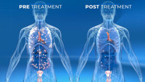 PSMA Pre Treatment and Post Treatment difference